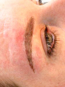dermatografie_litteken_na