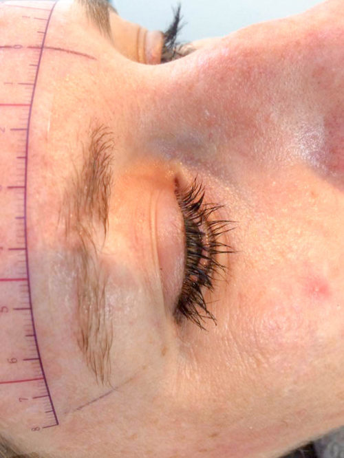 dermatografie_litteken_voor